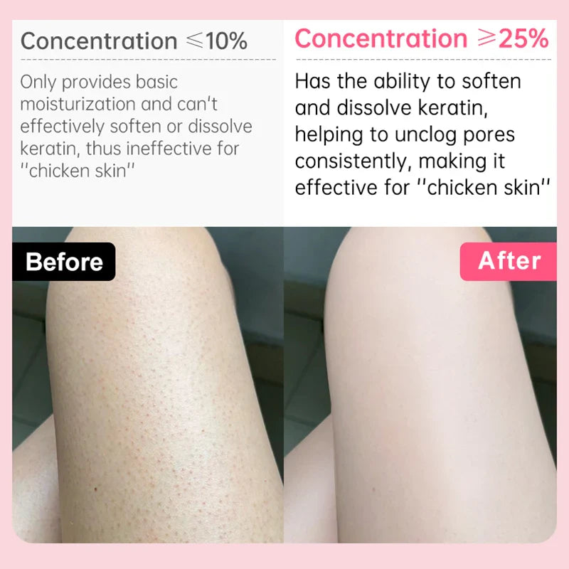 Body Cream Chicken Skin Removal Treatment Keratosis Pilaris Lotion Bumpy Rough Pore Spots Care Moisturizer Whitening Creams 60g